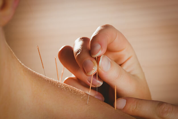 Acupuncture in Gurgaon,Acupuncture Therapy in Gurgaon